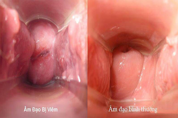 Hình ảnh viêm nhiễm phụ khoa - viêm âm đạo